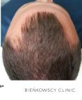 Przeszczep włosów - transplatacja włosów - Zdjęcie przed - Bieńkowscy Clinic®