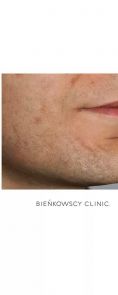 Lipofiling - przeszczep tłuszczu - Zdjęcie przed - Bieńkowscy Clinic®
