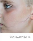 Narbenbehandlung - Vorher Foto - Bieńkowscy Clinic®