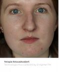 Fotoodmładzanie / odmładzanie skóry - Zdjęcie przed - Bieńkowscy Clinic®