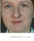 Fotoodmładzanie / odmładzanie skóry - Zdjęcie przed - Bieńkowscy Clinic®