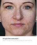 Fotoodmładzanie / odmładzanie skóry - Zdjęcie przed - Bieńkowscy Clinic®