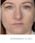 Fotoodmładzanie / odmładzanie skóry - Zdjęcie przed - Bieńkowscy Clinic®