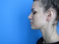 Operácia nosa (Rhinoplastika) - Fotka pred - GÉVÉ Klinika