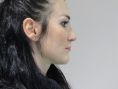 Operácia nosa (Rhinoplastika) - Fotka pred - GÉVÉ Klinika