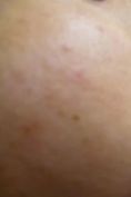 Dermal fillers - Photo before - Dr Catherine de Goursac
