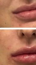 Augmentation des lèvres - acide hyaluronique ( MD code Di Maio avec Juvederm ou injection Restylane) pour de jolie lèvres. injection par Dr Delaoustre. Villa Ermitage Lambersart.