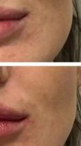 Augmentation des lèvres - acide hyaluronique ( MD code Di Maio avec Juvederm ou injection Restylane) pour de jolie lèvres. injection par Dr Delaoustre. Villa Ermitage Lambersart.