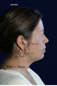 Liposucción - Foto Antes de - Dr. Marco Antonio Carmona M.D.