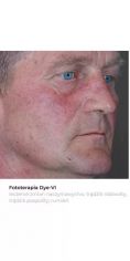 Spider veins laser removal (redness, birh marks) - Photo before - Bieńkowscy Clinic®