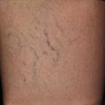 Eliminare capillari e teleangectasie con laser - Foto del prima - Dott. Dario d