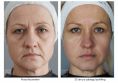 Fat (lipofiling) - Photo before - Dr n. med. Marcin Bieńkowski