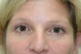 Eyelid surgery (Blepharoplasty) - Photo before - Dr. Nasim Huq M.S., FRCSC, M.Sc.,F.A.C.S. C.A.Q.S.H.