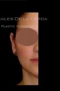 Ear surgery (Otoplasty) - Photo before - Dr. Rodrigo Morales De la Cerda