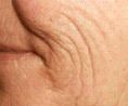Fotorejuvenation - Photo before - Klinika Laser Esthetic