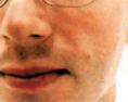 Laser skin tag removal - Photo before - Klinika Laser Esthetic