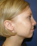 Rhinoplasty (Nose Job) - Photo before - Klinika Laser Esthetic