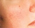 Spider veins laser removal (redness, birh marks) - Photo before - Klinika Laser Esthetic