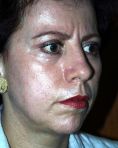 Fotorejuvenecimiento (IPL) - rejuvenecimiento de la piel - Foto Antes de - Dr. Aristides Arellano-Huacuja