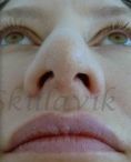 Septoplasty - Photo before - Dr. med. Jozefina Skulavik