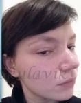 Septoplasty - Photo before - Dr. med. Jozefina Skulavik
