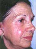 Mesotherapy (face, neck revitalization) - Photo before - Klinika Laser Esthetic