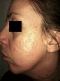 Acne laser, Cicatrici da acne laser - Foto del prima - Dott. Dario d