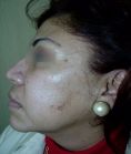 Fotorejuvenecimiento (IPL) - rejuvenecimiento de la piel - Foto Antes de - Dr. Aristides Arellano-Huacuja
