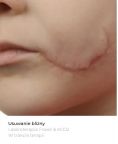 Scar removal - Photo before - Bieńkowscy Clinic®