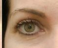 Blefaroplastica - Foto del prima - Skin Laser Clinic