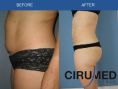 Liposucción - Foto Antes de - Cirumed Clinic