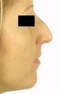 Rhinoplasty (Nose Job) - Photo before - Klinika Laser Esthetic