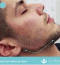 Radiesse (Calcium hydroxylapatit) - Fotka pred - Chirkoz Medical Clinic