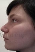 Septoplasty - Photo before - Dr. med. Jozefina Skulavik