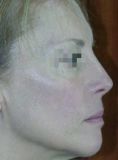 Fotorejuvenecimiento (IPL) - rejuvenecimiento de la piel - Foto Antes de - Dr. Aristides Arellano-Huacuja