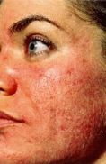 Laser acne treatment - Photo before - Klinika Laser Esthetic