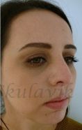 Septoplasty - Photo before - Dr. med. Jozefina Skulavik