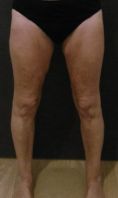 Lifting non chirurgical - Résultats après 5 séances par Velashape de la face antérieure des cuisses chez une patiente de 72 ans.