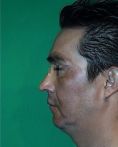 Fotorejuvenecimiento (IPL) - rejuvenecimiento de la piel - Foto Antes de - Dr. Aristides Arellano-Huacuja