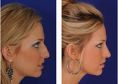 Rhinoplasty (Nose Job) - Photo before - Michel Siegel MD