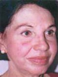 Chemical peeling - Photo before - Klinika Laser Esthetic