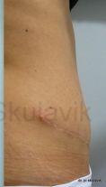 Abdominoplasty (Tummy Tucks) - Photo before - Dr. med. Jozefina Skulavik