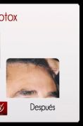 Botox/Dysport - Eliminar arrugas - Foto Antes de - Dr. Aristides Arellano-Huacuja