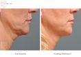 Ultherapy - Photo before - Dr n. med. Marcin Bieńkowski