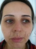Septoplasty - Photo before - Dr. med. Jozefina Skulavik