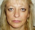 Eyelid surgery (Blepharoplasty) - Photo before - Klinika Laser Esthetic