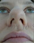 Septoplasty - Photo before - Dr. med. Jozefina Skulavik