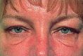 Eyelid surgery (Blepharoplasty) - Photo before - Klinika Laser Esthetic