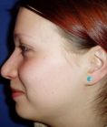 Rhinoplasty (Nose Job) - Photo before - Klinika Laser Esthetic