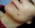 Laser skin tag removal - Photo before - Klinika Laser Esthetic